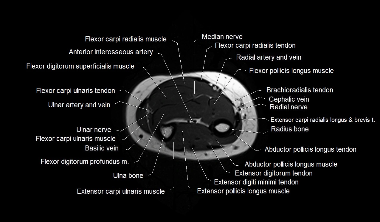 MRI 3T forearm axial cross sectional anatomy image 35.webp